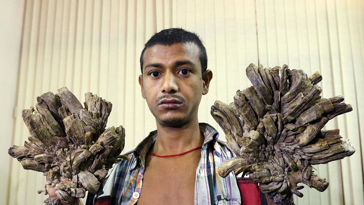 Tree man syndrome: Condition leaves sufferers with skin like bark